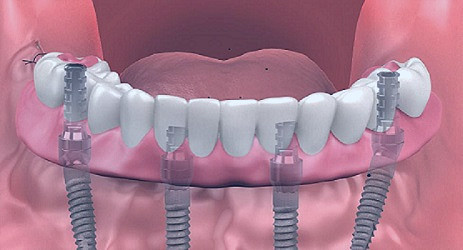 What are full mouth dental implants and what do they cost? - TeethXpress